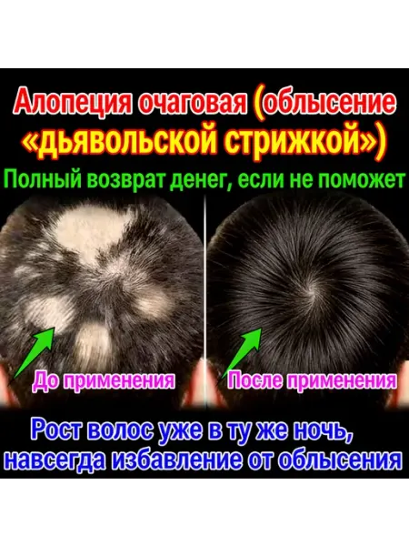 Лосьон от гнездной алопеции