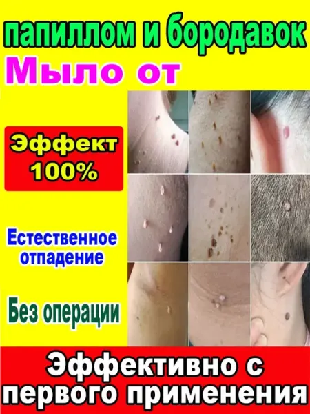 Мыло от папиллом и бородавок