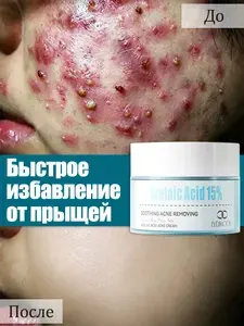 LYDIMOON Крем для лица от прыщей с салициловая кислота, азелаиновая кислота для жирной проблемной кожи лица от прыщей, постакне, 30 мл
